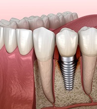 Woman with dental implant toward the front of her mouth